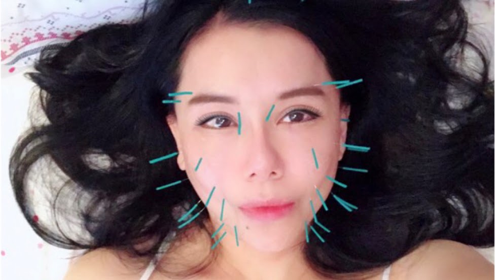 美容鍼灸TAKAHINA